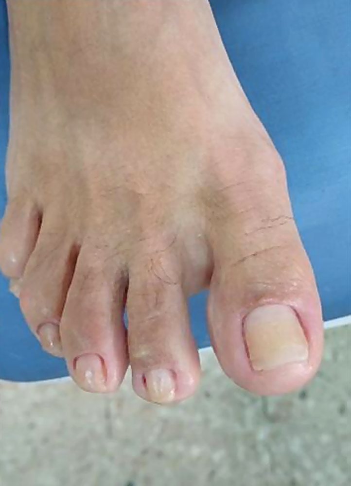 Onicofose, depois do tratamento