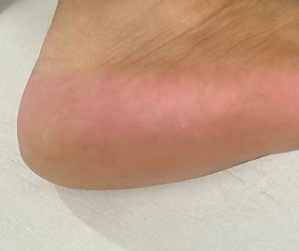 Calcanhar rachado, depois do tratamento